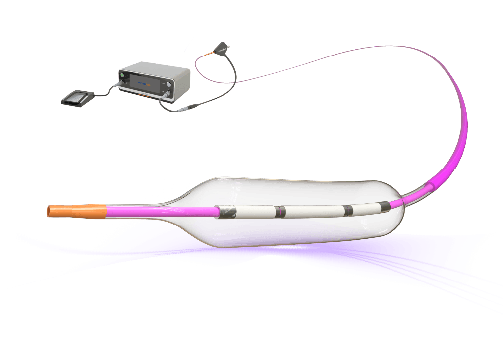 Illustration of the Sonico-CX coronary intravascular lithotripsy balloon catheter treating a calcified vessel